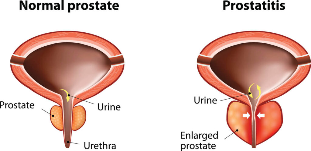 The Best Guidance For Prostate Gland Enlargement Treatment You Could Ever Need