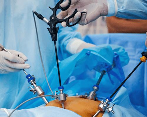 Laparoscopy