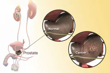 What is Prostate Cancer? Risk factors, Preventions, Types, and How Dr Sandeep Nunia can help you to cure it.