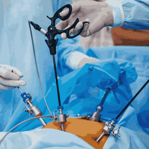 laparoscopy
